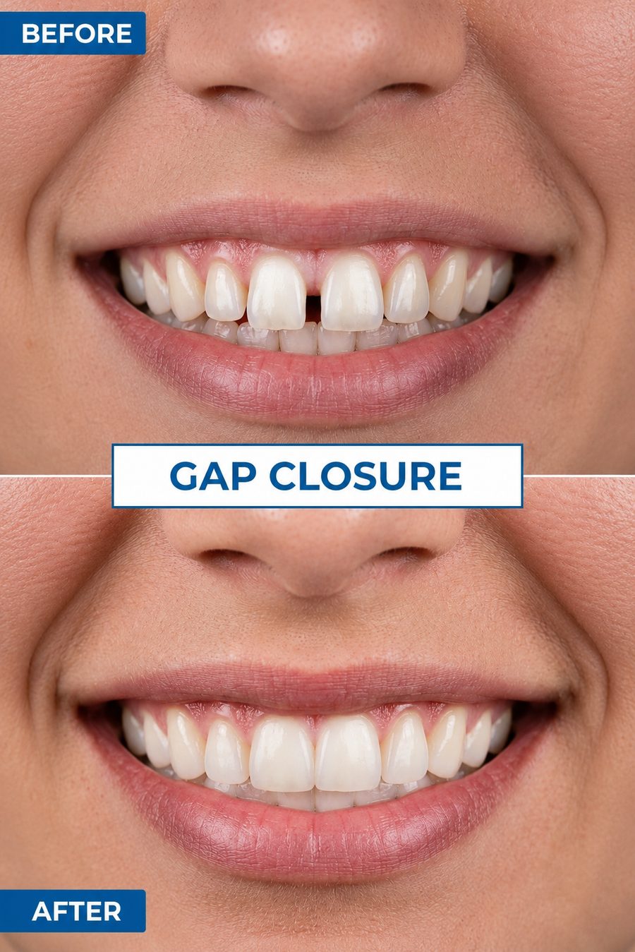 Before and after gap closure smile transformation